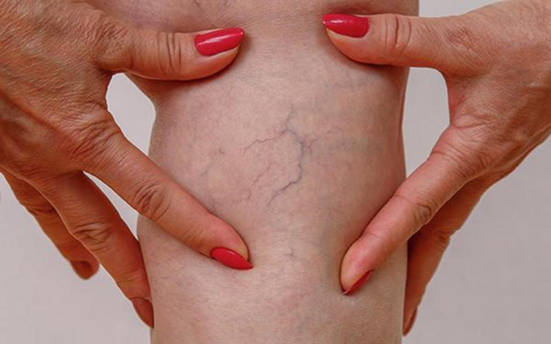 تأثیر آب گرم بر بیماری‌های وریدی