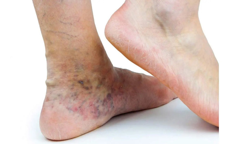 جکوزی برای درمان یا پیشگیری از واریس